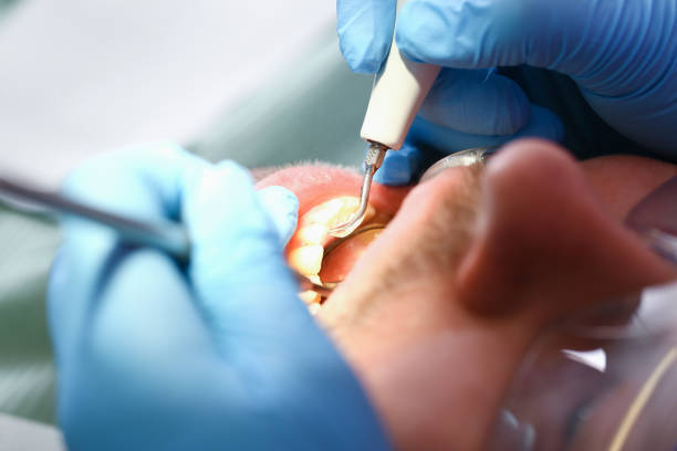 Best Emergency Treatment for Dental Infections or Abscesses in West Mayfield, PA